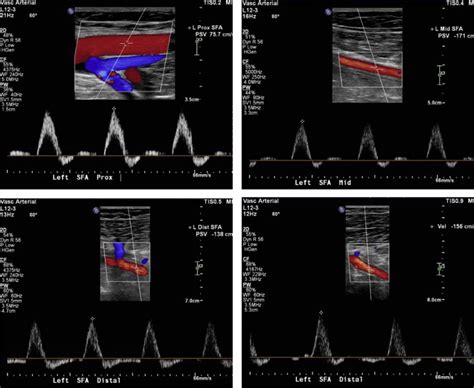 Deep Femoral Artery Ultrasound