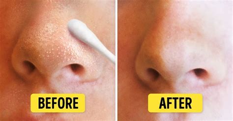 8 Natural Ways To Get Rid Of Blackheads And Whiteheads Fast Get Rid