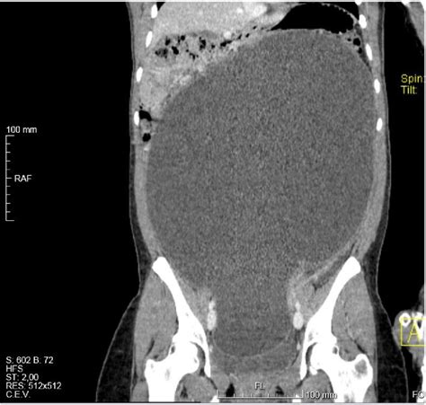 Figure 4 From Giant Abdominal Cyst In A Young Female Patient A Case