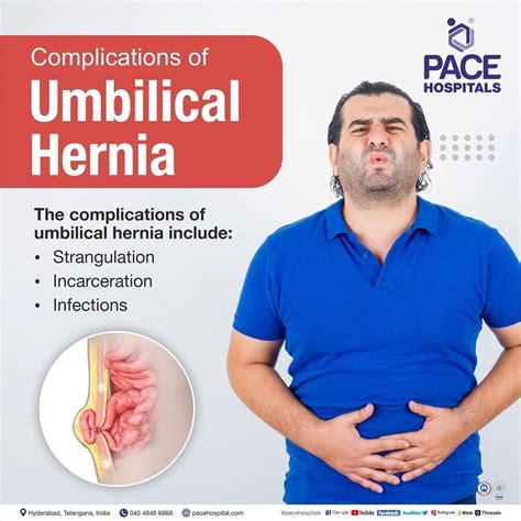 Umbilical Hernia Symptoms Causes Complications And Prevention