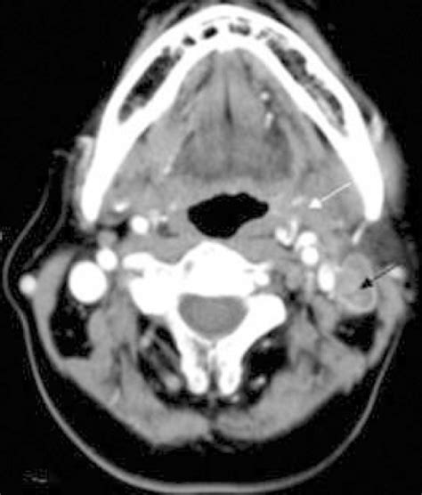 Axial View Of The Neck Ct With Enhancement Revealed Mul Open I