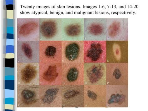 Skin Cancers Pictures Early Stages Pictures Photos