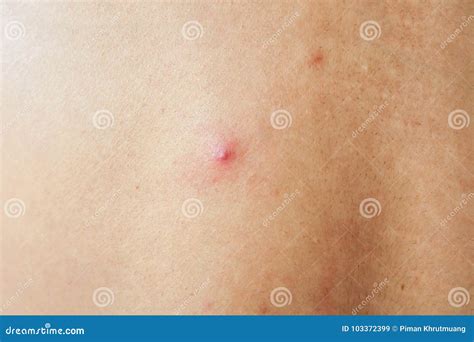 Acne With Red Spots Stock Image Image Of Back White 103372399