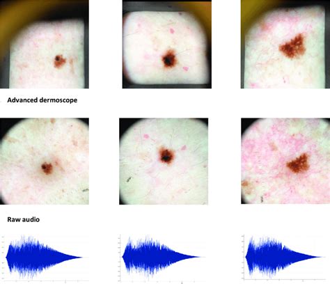 Comparison Of Benign Nevus Left Dysplastic Nevus Middle And