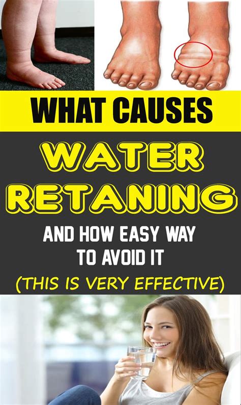 What Causes Water Retention And How To Avoid It Swollen Hands Health