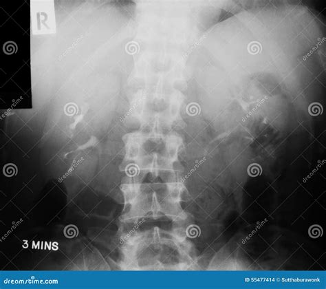 X Ray Image Of Ivpintravenous Pyelogram Stock Photo Image 55477414