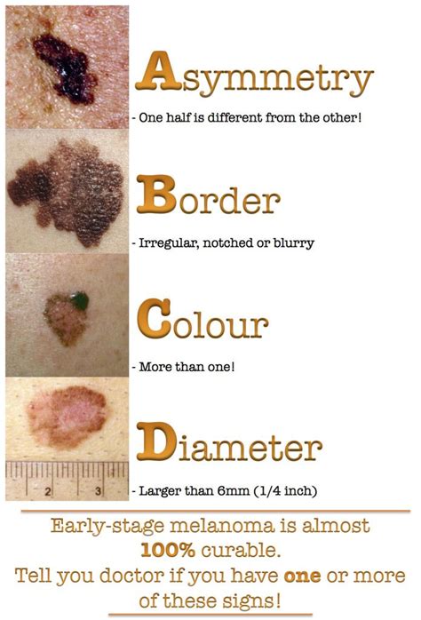 The First Sign Of Melanoma Is A Change In Size Shape Or Color Of An