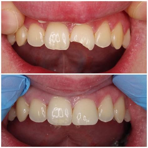 Same Day Fractured Tooth Repair Dental Photos Dental Images Chipped