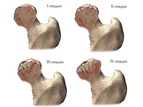 Avascular Necrosis Of The Femoral Head ONBK