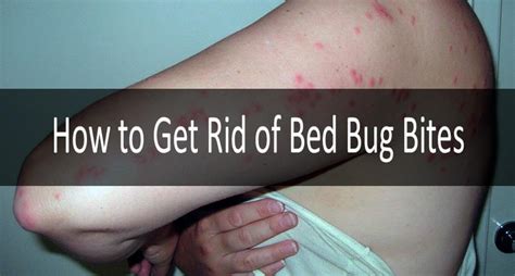 Bed Bug Bites Definite Symptoms And Signs And Their Treatment Strategy