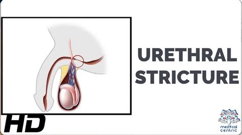 Urethral Stricture A Painful Reality For Many Men Youtube