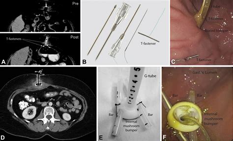 Different Endoscopic Management Of 2 Cases Of Acute Buried Bumper