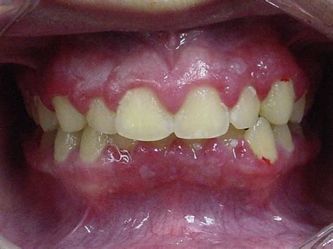 References In Oral Manifestations Of Viral Infections Atlas Of The