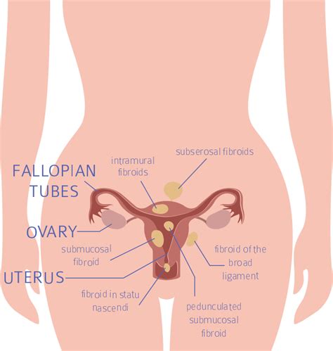 Heavy Periods Causes And Treatment Gynaecologist Perkins