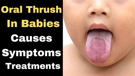 Oral Thrush Treatment Oral Thrush Causes How To Get Rid Of Oral