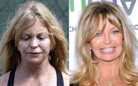Actress Goldie Hawn Plastic Surgery Before And After 2022