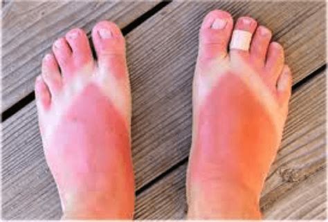 Summer Is Here Your Lower Legs And Feet Are At Higher Risk For Sunburn
