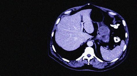 Gastrointestinal Stromal Tumor Gist Symptoms Treatment Outlook