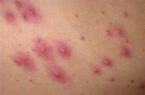 Recognizing And Treating Bacterial Folliculitis Sports Medicine Review