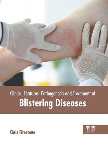 Clinical Features Pathogenesis And Treatment Of Blistering Diseases A
