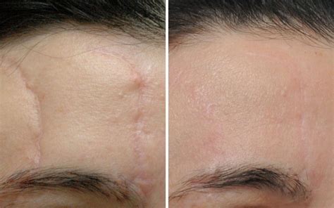 Post Surgical Scar Treatments In Dubai Scar Revision Laser Skin