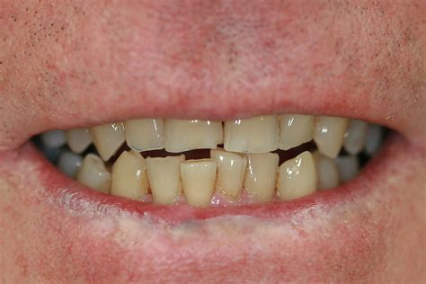 Tooth Coloured Composite Reconstruction Southampton Cosmetic Dentist