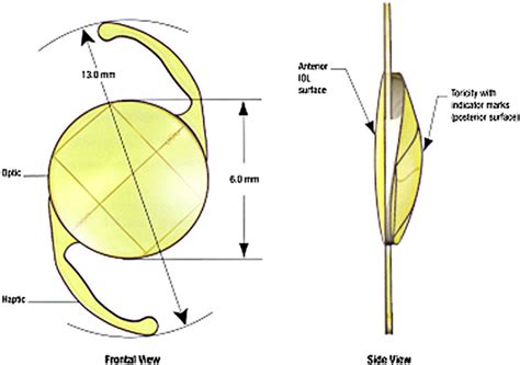 Figure From Foldable Toric Intraocular Lens For Astigmatism Correction In Cataract Patients