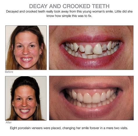 For those who have very worn out and crowded teeth, we may do a short course of invisalign before restoring the proper shape of the teeth with veneers. 97 best Porcelain Veneers Before and After images on ...