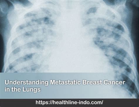 understanding metastatic breast cancer in the lungs healthline indonesia