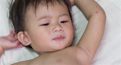 How Can I Treat My Babys Eczema At Home Babycenter