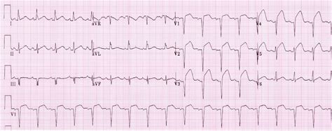 Association of ecg parameters with late gadolinium enhancement and outcome in patients with clinical suspicion of acute or subacute myocarditis referred for cmr imaging. Study Medical Photos: Acute Anterior Myocardial Infarction - ECG