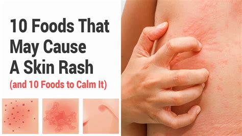 10 Foods That May Cause A Skin Rash And 10 Foods To Calm It