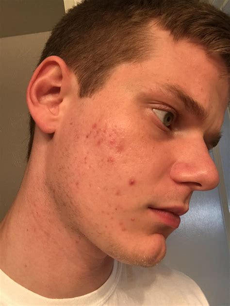 Would You Say This Is Mildmoderatesevere Acne Racne