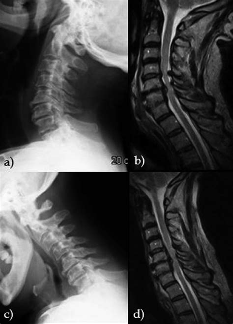 Cervical Spine MRI In Extended A B And Flexed C D Position The