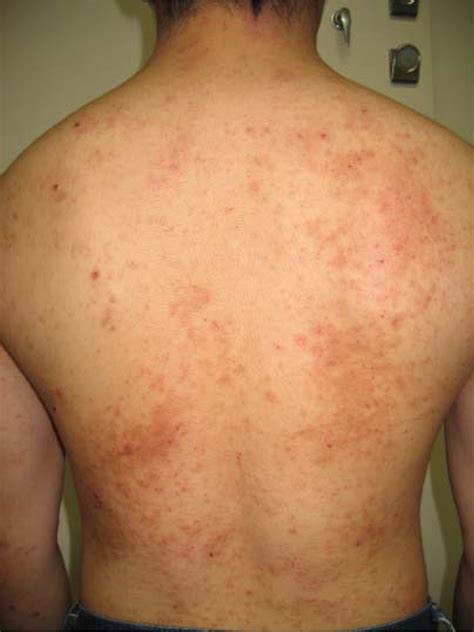 A Case Report Of Acute Dermatitis That Developed During An Experiment