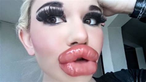 Woman With Largest Lips In The World Parades Her New Pout After Th Injection You