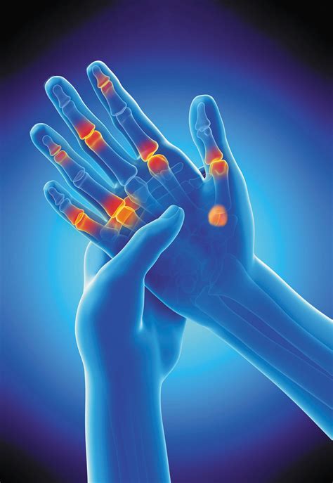 Identifying Arthritis In Your Fingers And Thumbs Harvard Health