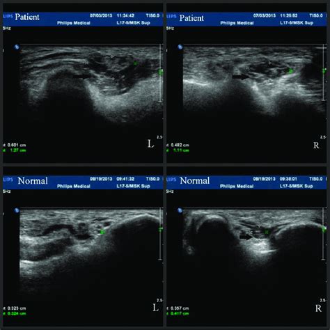 High Resolution Sonography Of Ulnar Nerve Examination Demonstrated