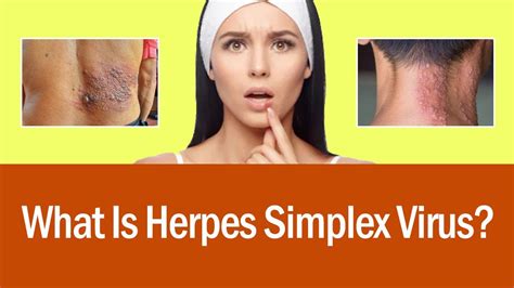 What Is Herpes Simplex Virus Signs And Symptoms How To Cure Herpes