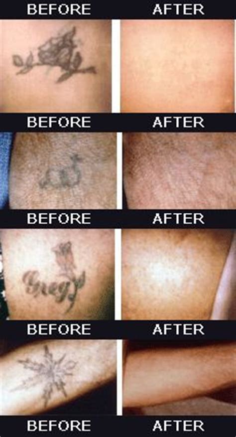 More complicated tattoo removals requiring extensive skin removal, anesthesia, and skin grafts run upwards of $10,000. 1000+ images about Tattoo Removal Before and After on ...