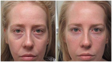 67 Inspired For What Is The Best Filler For Under Eye Wrinkles Home