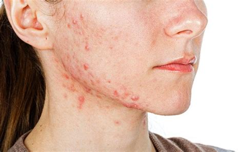 How To Identify And Treat Nodular Acne Skinkraft