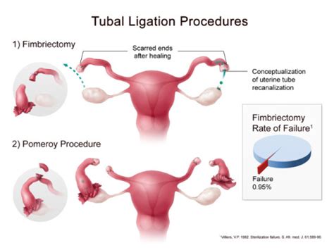 Tubal Ligation Crabdiving