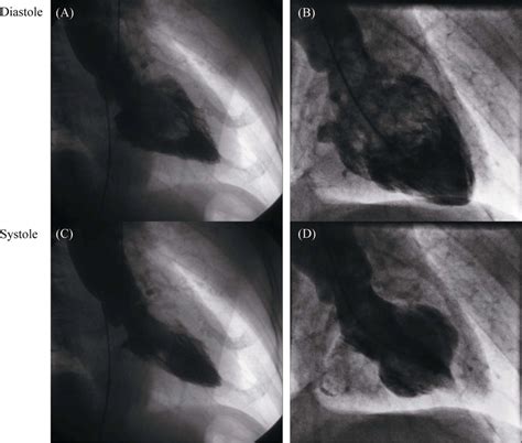 Laevo Cardiography Of Patients With Recurrent Apical Ttc Left Panel