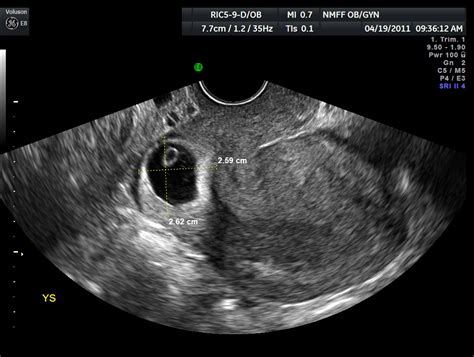 Normal Uterus Size In Cm Ultrasound Slidesharedocs