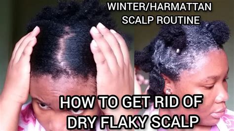 How To Get Rid Of Dry Flaky Scalp Winter Harmattan Scalp Routine