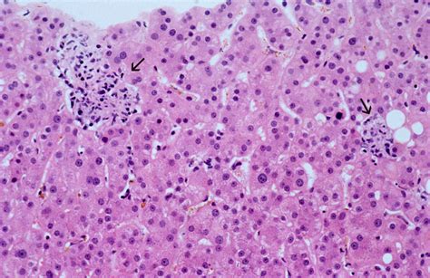 Liver Disseminated Histoplasmosis Wellcome Collection