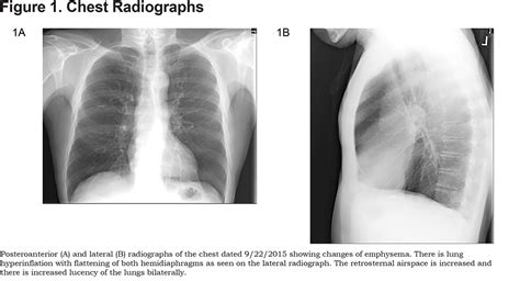 Chest X Ray Of A Copd Patient Perokok G
