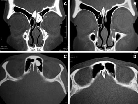 Ct Images Of A Patient With A Left Fronto Ethmoidal Osteoma A Pre Op