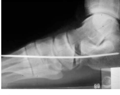 Figure 4 From Calcaneocuboid Distraction Arthrodesis And First